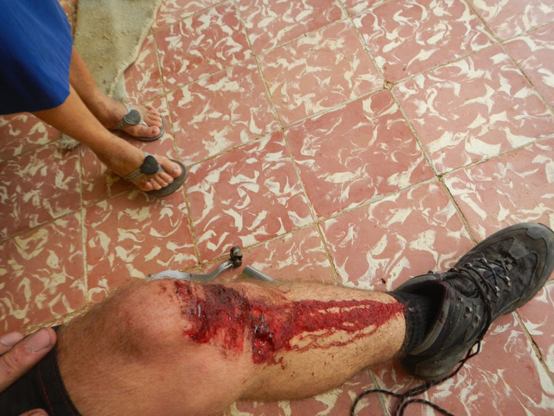 motorcycle leg injury motorcycle leg injury